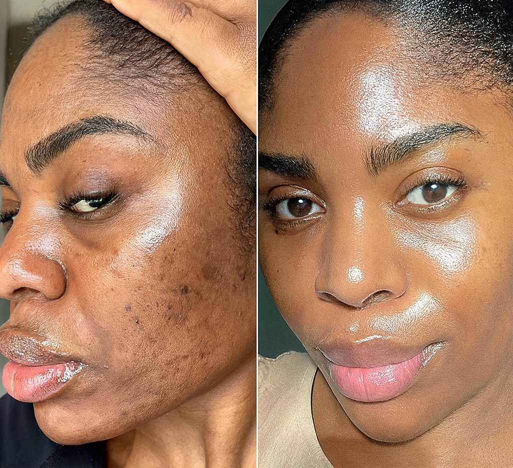 Before - Glowsy AcneClear Face Wash